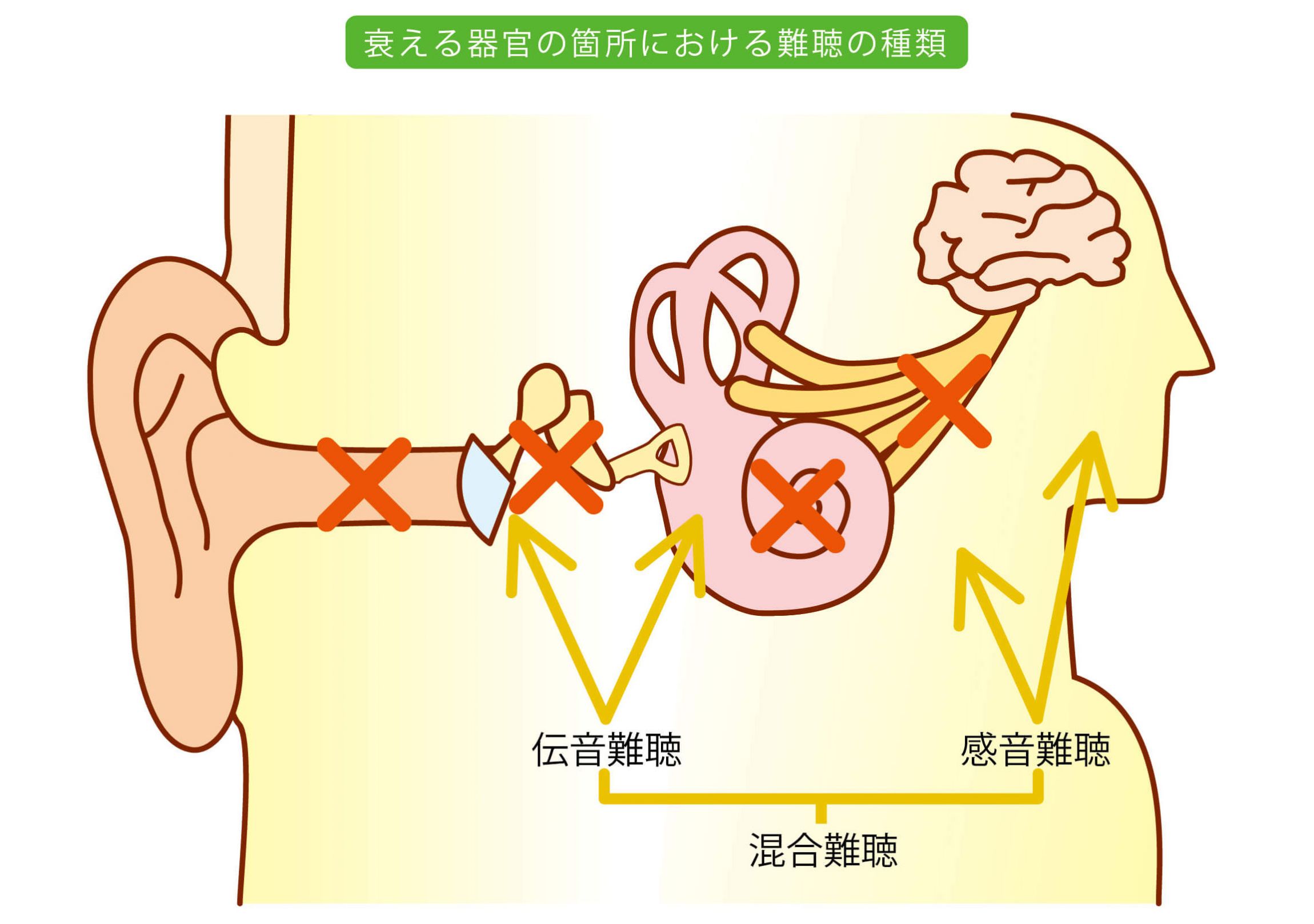 軽度 の 老人 性 難聴 の 特徴 は どれ か